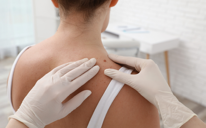 Melanoma benigno o maligno: come riconoscerlo e cosa fare