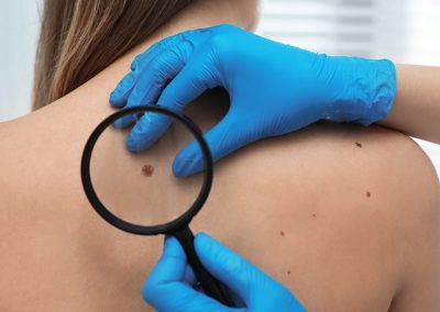 In cosa consiste la mappatura dei nei